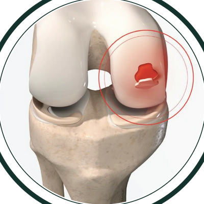 Uszkodzenie łąkotki