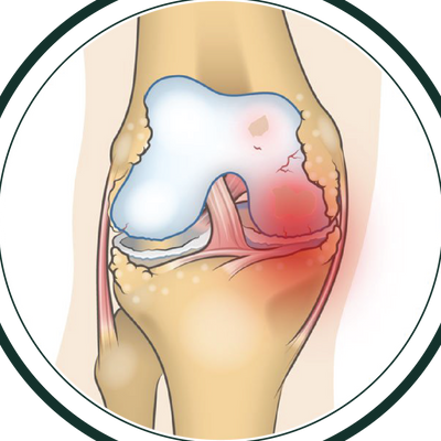 Codzienny ból kolana