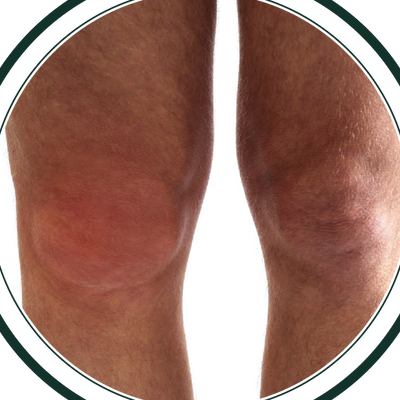 Obrzęk i sztywność